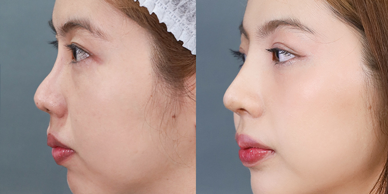 8 cách làm mũi cao tự nhiên mà vẫn an toàn theo chuẩn công nghệ mới nhất hiện nay 7 8 cách làm mũi cao tự nhiên