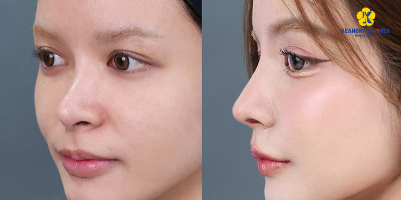 8 cách làm mũi cao tự nhiên mà vẫn an toàn theo chuẩn công nghệ mới nhất hiện nay 5 8 cách làm mũi cao tự nhiên