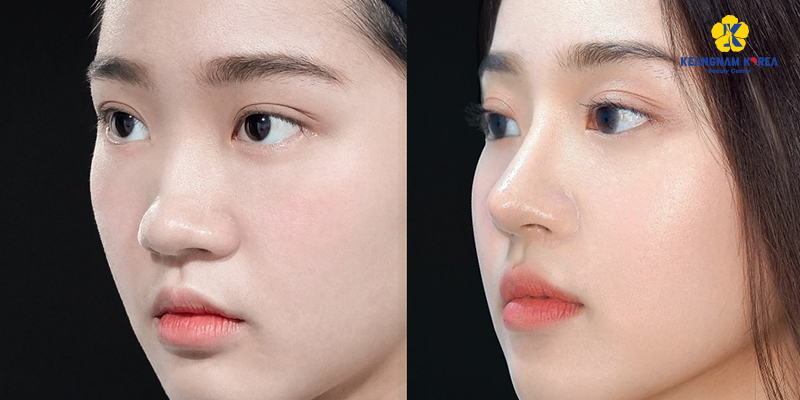 Nâng mũi bằng sụn tai có tốt không? Có đau không? Giữ được bao lâu? 3 Nâng mũi bọc sụn tai được bao lâu?