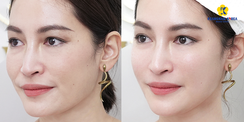 Review top 5 công nghệ nâng cơ mặt trẻ hóa hàng đầu 2026: Ultherapy, HIFU, RF, Softwave hay tiêm? 3 Công nghệ nâng cơ mặt