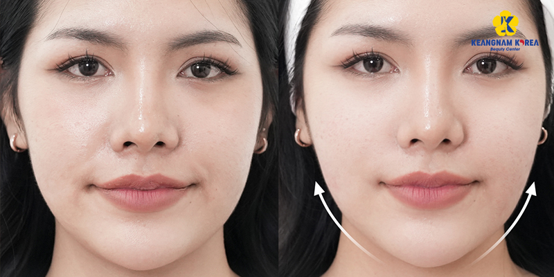 Review top 5 công nghệ nâng cơ mặt trẻ hóa hàng đầu 2026: Ultherapy, HIFU, RF, Softwave hay tiêm? 4 Công nghệ nâng cơ mặt 2026