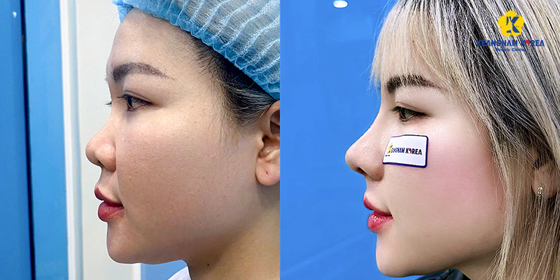 Dậy thì có làm mũi cao lên không? 4 dậy thì có làm mũi cao lên không