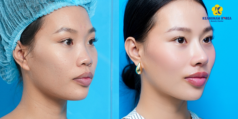 Dậy thì có làm mũi cao lên không? 5 dậy thì có làm mũi cao lên không