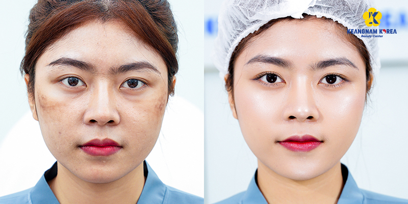 Giá meso không kim trung bình bao nhiêu? Tiêm ở đâu tốt? 5 trước và sau khi thực hiện meso không kim