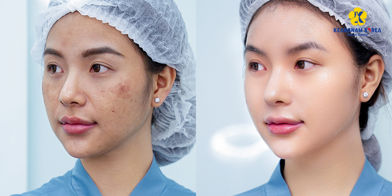 Giá meso không kim trung bình bao nhiêu? Tiêm ở đâu tốt? 6 meso không kim keangnam korea