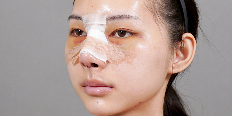 Những hiện tượng sau khi nâng mũi là gì? Đâu là dấu hiệu bình thường và bất thường cần tuyệt đối lưu tâm? 2 Những hiện tượng bình thường sau khi nâng mũi