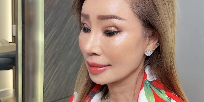 Nâng mũi gồm những phương pháp nào? Giá bao nhiêu? Bao lâu thì đẹp? Có nguy hiểm không? Các kinh nghiệm và rủi ro thường gặp 11 Hình ảnh nâng mũi thực tế sau khi về già tại Keangnam Korea