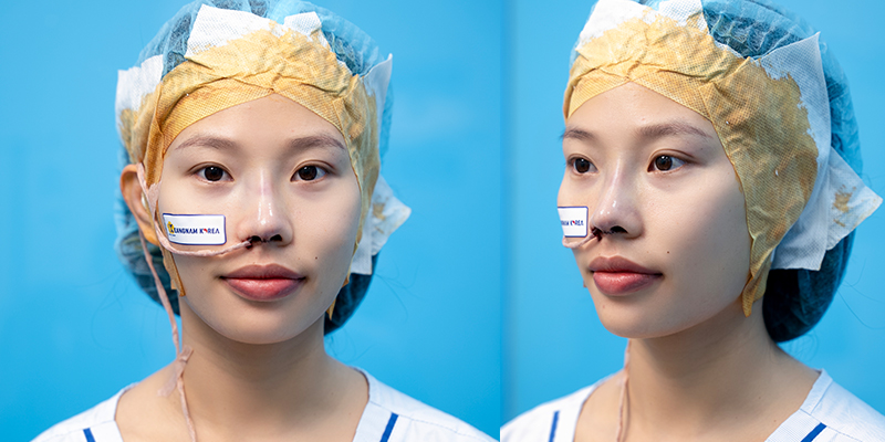 Nâng mũi gồm những phương pháp nào? Giá bao nhiêu? Bao lâu thì đẹp? Có nguy hiểm không? Các kinh nghiệm và rủi ro thường gặp 10 Hình ảnh nâng mũi thực tế tại Keangnam Korea