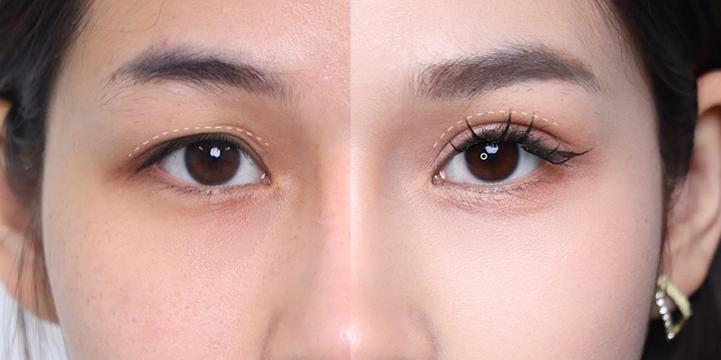 Lấy mỡ mí mắt trên bao nhiêu tiền? Nên cắt mỡ mắt trên ở đâu? 4 lấy mỡ mí mắt trên bao nhiêu tiền