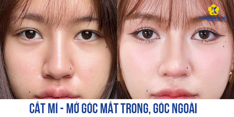 Mở góc mắt ngoài có tác dụng gì? So sánh và hình ảnh thực tế khi mở góc mắt trong và ngoài 2 Mở góc mắt ngoài hạ xếch