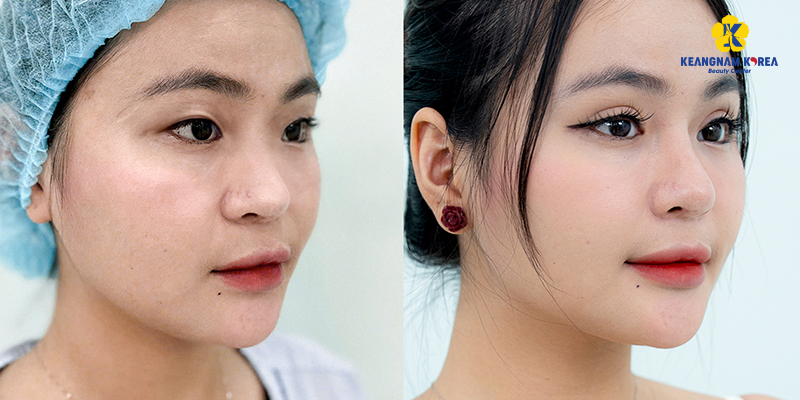 Mở góc mắt ngoài có tác dụng gì? So sánh và hình ảnh thực tế khi mở góc mắt trong và ngoài 3 Mở góc mắt ngoài hạ xếch