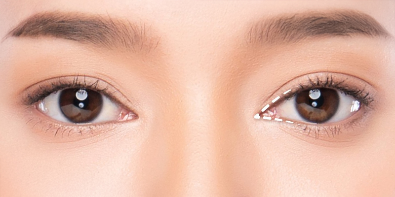 Mở góc mắt ngoài có tác dụng gì? So sánh và hình ảnh thực tế khi mở góc mắt trong và ngoài 1 Mở góc mắt ngoài là gì?