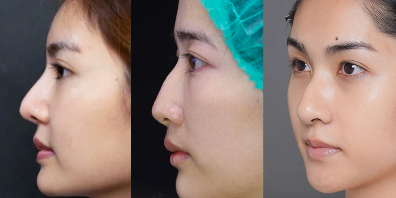 Mũi gồ là gì? Trong tướng số có tốt không? Đâu là cách khắc phục mũi gồ phổ biến nhất 2 mũi gồ là gì