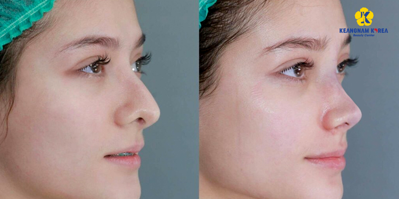 Mũi gồ là gì? Trong tướng số có tốt không? Đâu là cách khắc phục mũi gồ phổ biến nhất 4 giá sửa mũi gồ