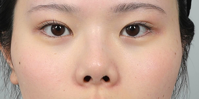 Mũi hếch là gì? Có ý nghĩa gì trong nhân tướng học? Đâu là cách khắc phục hiệu quả để thay đổi vận số? 2 mũi hếch là gì