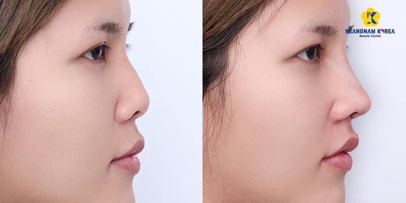 Mũi hếch là gì? Có ý nghĩa gì trong nhân tướng học? Đâu là cách khắc phục hiệu quả để thay đổi vận số? 4 mũi hếch là sao