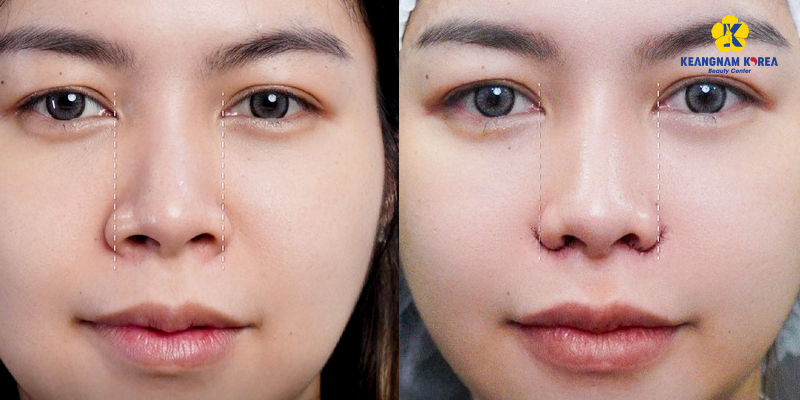 Mũi hếch là gì? Có ý nghĩa gì trong nhân tướng học? Đâu là cách khắc phục hiệu quả để thay đổi vận số? 5 hình ảnh thực tế khi nâng mũi hếch