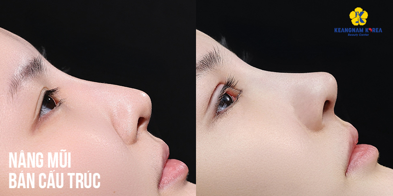 Nâng mũi bán cấu trúc là gì? Giá bao nhiêu? Có vĩnh viễn không? Ưu nhược điểm so với nâng mũi cấu trúc 5 nâng mũi cấu trúc và bán cấu trúc