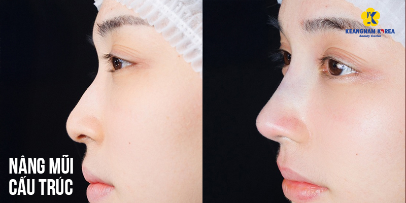 Nâng mũi bán cấu trúc là gì? Giá bao nhiêu? Có vĩnh viễn không? Ưu nhược điểm so với nâng mũi cấu trúc 6 mũi bán cấu trúc và mũi cấu trúc