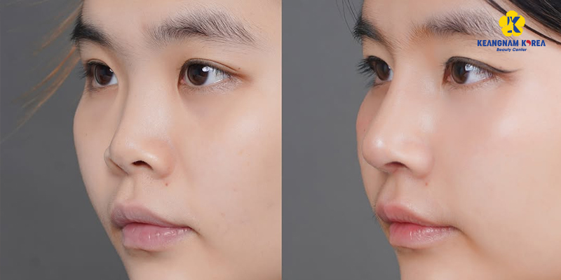 Nâng mũi bằng sụn nhân tạo có vĩnh viễn không? 4 hình ảnh nâng mũi bằng sụn nhân tạo