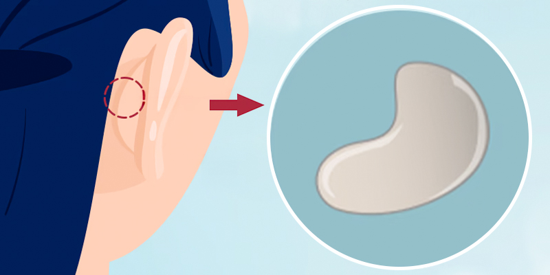 Nâng mũi bằng sụn tai có tốt không? Có đau không? Giữ được bao lâu? 2 Lấy sụn tai có đau không?