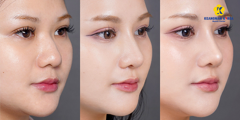 So sánh nâng mũi thường và nâng mũi cấu trúc. Phương pháp nào hiệu quả hơn? 4 nâng mũi cấu trúc