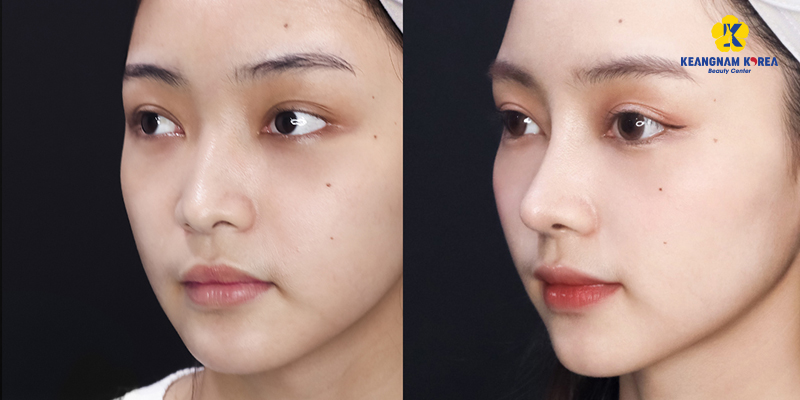 Nâng mũi Pureform là gì? Giá bao nhiêu 3 Nâng mũi cấu trúc Pureform