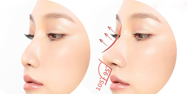 Nâng mũi Pureform là gì? Giá bao nhiêu 2 Nâng mũi Pureform