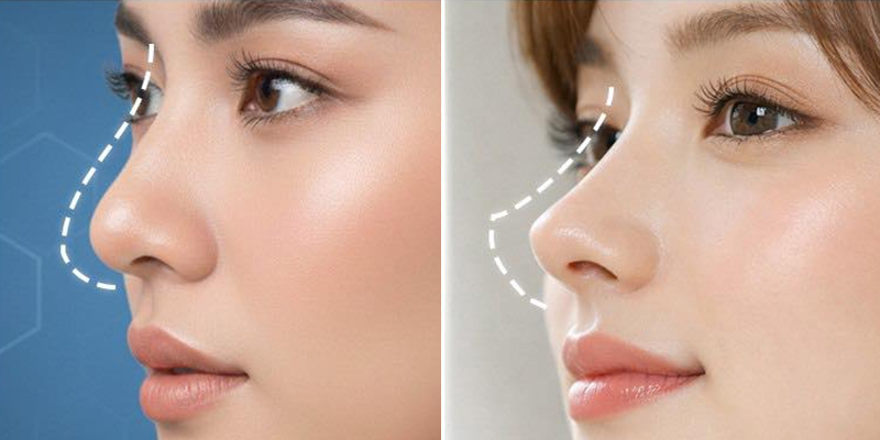 So sánh nâng mũi thường và nâng mũi cấu trúc. Phương pháp nào hiệu quả hơn? 1 nâng mũi thường và nâng mũi cấu trúc