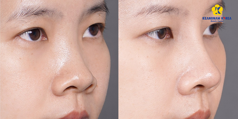 So sánh nâng mũi thường và nâng mũi cấu trúc. Phương pháp nào hiệu quả hơn? 3 nâng mũi thường