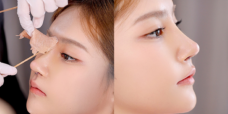 Những hiện tượng sau khi nâng mũi là gì? Đâu là dấu hiệu bình thường và bất thường cần tuyệt đối lưu tâm? 1 Những hiện tượng sau khi nâng mũi