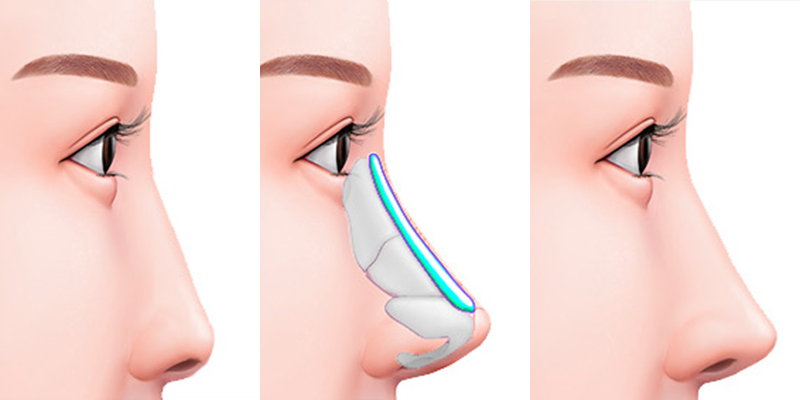 Nâng mũi bán cấu trúc là gì? Giá bao nhiêu? Có vĩnh viễn không? Ưu nhược điểm so với nâng mũi cấu trúc 2 minh họa nâng mũi bán cấu trúc là gì