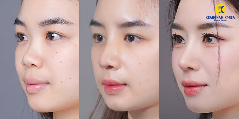 Nâng mũi bằng sụn tai có tốt không? Có đau không? Giữ được bao lâu? 4 Ưu điểm nổi bật của nâng mũi sụn tai