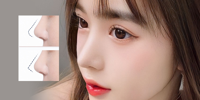 How Much Is Rhinoplasty in Vietnam? 2026 Prices & Stay Duration 1 rhinoplasty in vietnam
