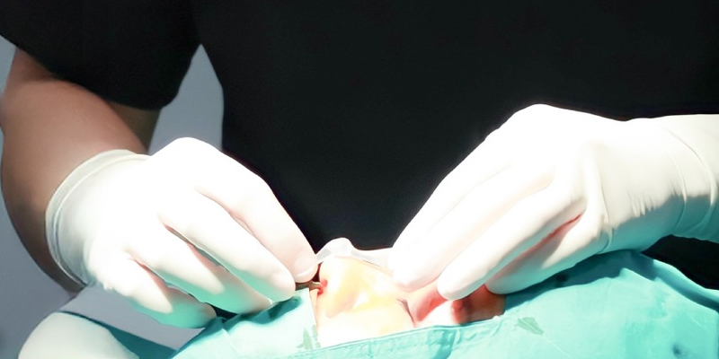 semi structural rhinoplasty