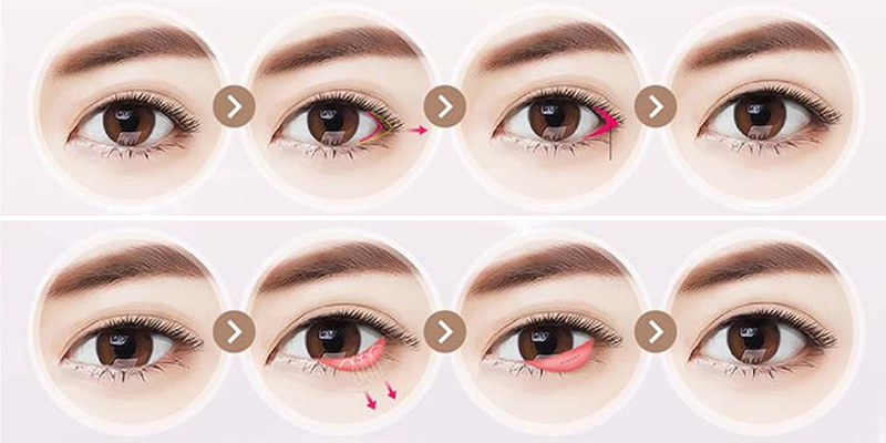 Mở góc mắt ngoài có tác dụng gì? So sánh và hình ảnh thực tế khi mở góc mắt trong và ngoài 6 so sanh mo goc mat trong va mo goc mat ngoai