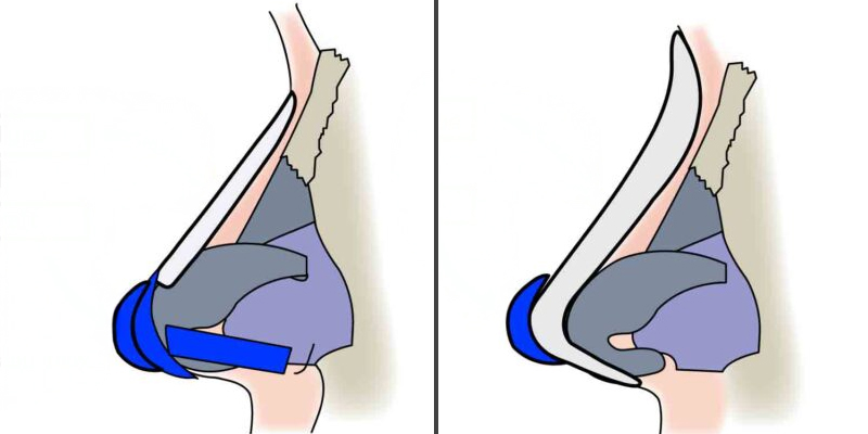 So sánh nâng mũi thường và nâng mũi cấu trúc. Phương pháp nào hiệu quả hơn? 2 so sánh nâng mũi thường và nâng mũi cấu trúc