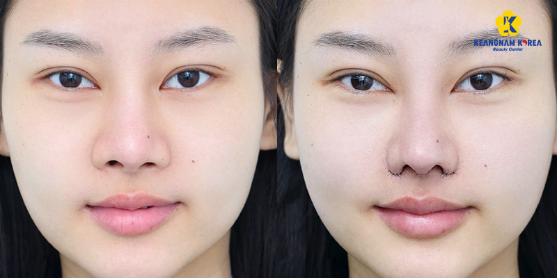 Thu gọn cánh mũi có làm mũi cao hơn không? 2 thu gọn cánh mũi có làm mũi cao hơn không