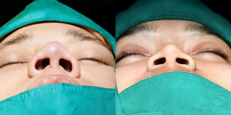 Thu gọn cánh mũi có làm mũi cao hơn không? 4 thu gọn cánh mũi có làm mũi cao hơn không