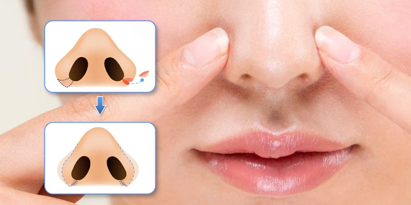 Thu gọn cánh mũi có làm mũi cao hơn không? 3 thu gọn cánh mũi có làm mũi cao hơn không