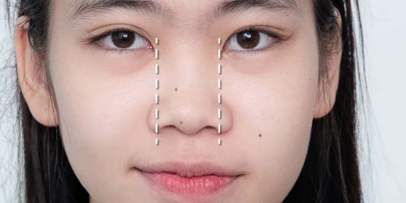 Nên thu gọn cánh mũi hay nâng mũi? 6 rủi ro khi thẩm mỹ mũi