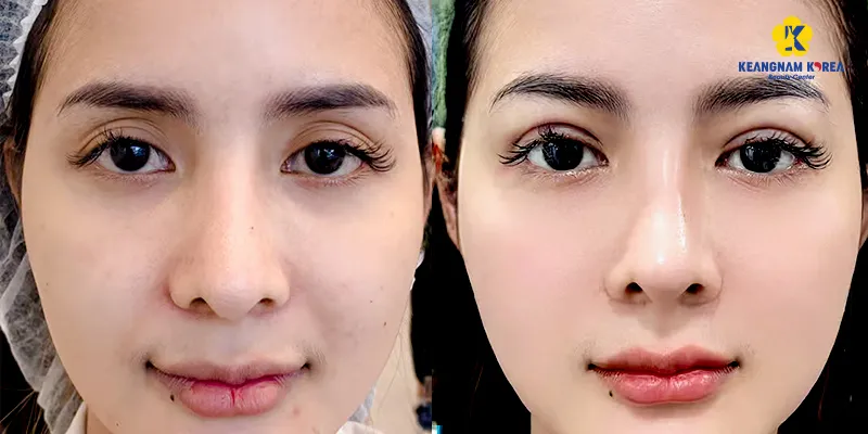 Cấy mỡ tự thân hốc mắt là gì? Ưu nhược điểm ra sao? Có nguy hiểm không? Đâu là các chống chỉ định của bác sĩ 2 Cấy mỡ tự thân hốc mắt