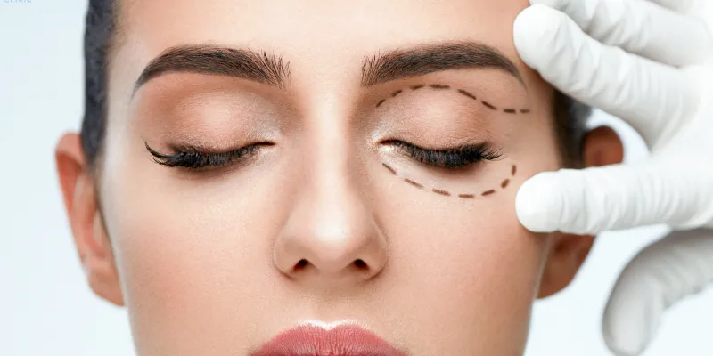 Cấy mỡ tự thân hốc mắt