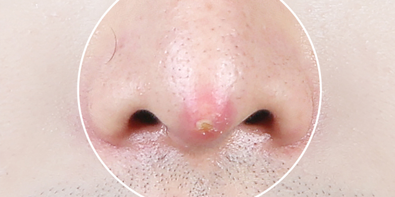 Dấu hiệu nâng mũi không hợp sụn: Nhận biết sớm để tránh biến chứng nguy hiểm 3 dấu hiệu nâng mũi không hợp sụn