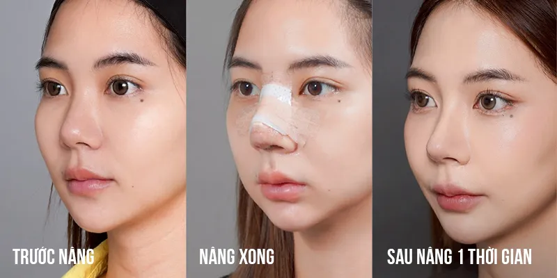 Nâng mũi 1 tháng đầu mũi bị đỏ, nguyên nhân là gì? Làm sao để khắc phục? 2 Nâng mũi 1 tháng đầu mũi bị đỏ