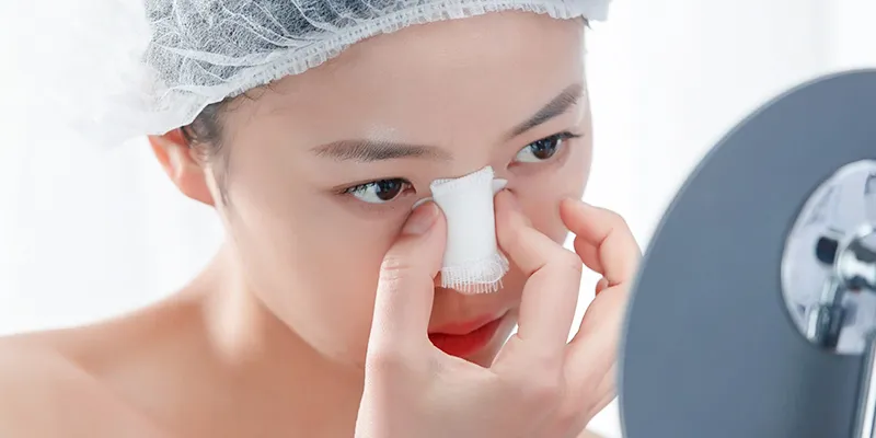 Nâng mũi 1 tháng đầu mũi bị đỏ, nguyên nhân là gì? Làm sao để khắc phục? 3 Nâng mũi 1 tháng đầu mũi bị đỏ