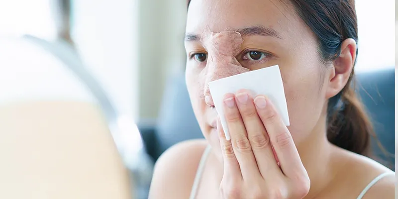 Nâng mũi 1 tháng đầu mũi bị đỏ, nguyên nhân là gì? Làm sao để khắc phục? 5 Nâng mũi 1 tháng đầu mũi bị đỏ