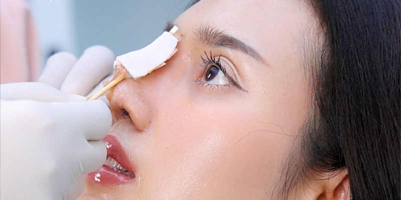 Nâng mũi bọc cân cơ thái dương là gì? 5 Nâng mũi bọc cân cơ thái dương là gì