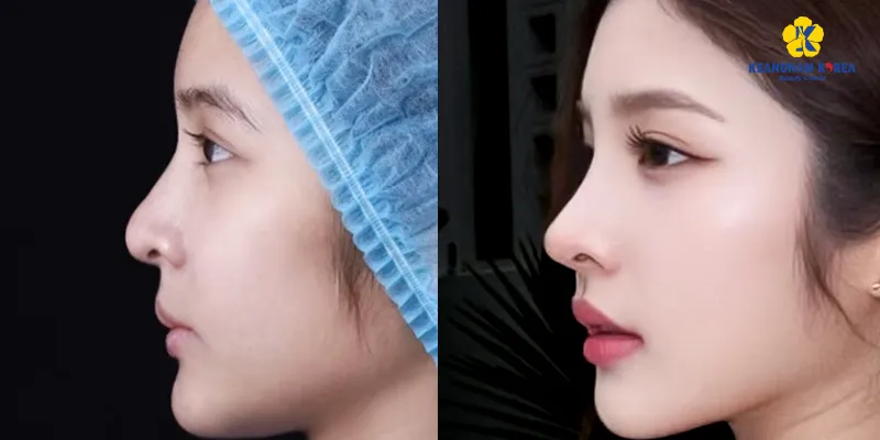 Có những loại nâng mũi nào? Tổng hợp các phương pháp thẩm mỹ mũi thịnh hành nhất 4 Nâng mũi cấu trúc