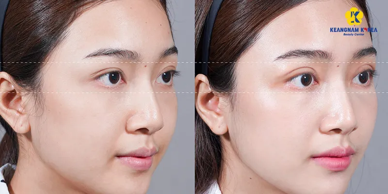 Bắn plasma mắt là gì? 2 bắn plasma mắt